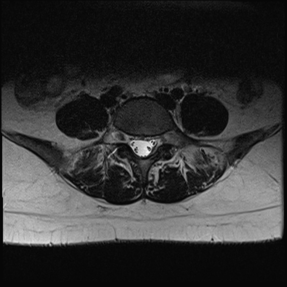 File:Normal lumbar spine MRI- 3 T (Radiopaedia 53280-59250 Axial T2 24).jpg