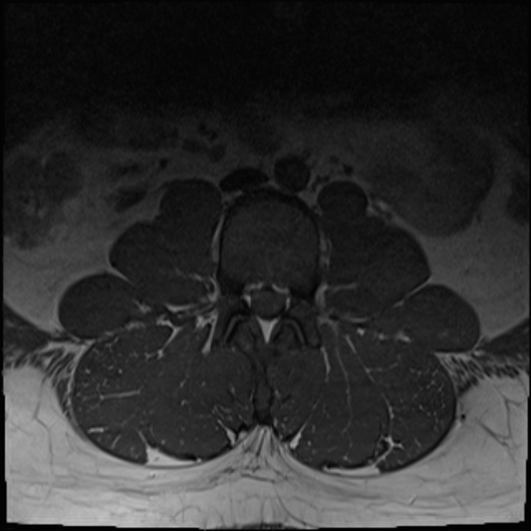 File:Normal lumbar spine MRI (Radiopaedia 47857-52609 Axial T1 1).jpg