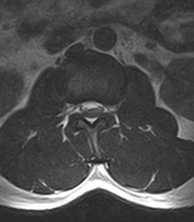 Normal lumbar spine MRI - low-field MRI scanner (Radiopaedia 40976-43699 Axial T2 32).jpg