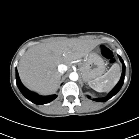File:Normal multiphase CT liver (Radiopaedia 38026-39996 B 15).jpg