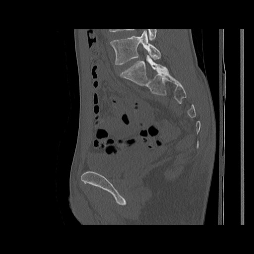 Normal pelvis (Radiopaedia 51473-57238 Sagittal bone window 84).jpg