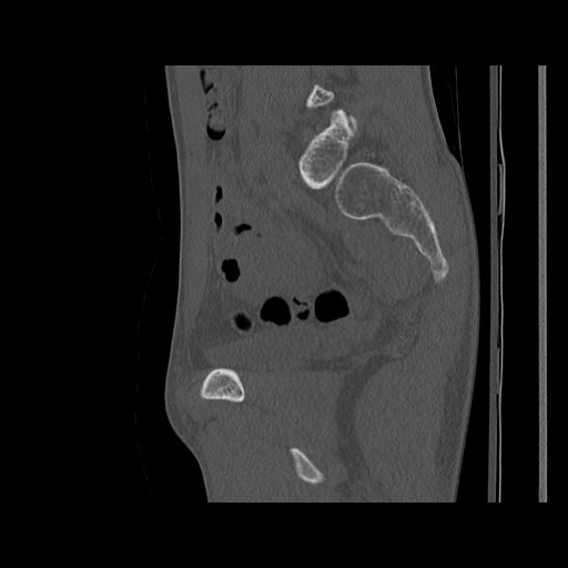 Normal pelvis (Radiopaedia 51473-57238 Sagittal bone window 91).jpg
