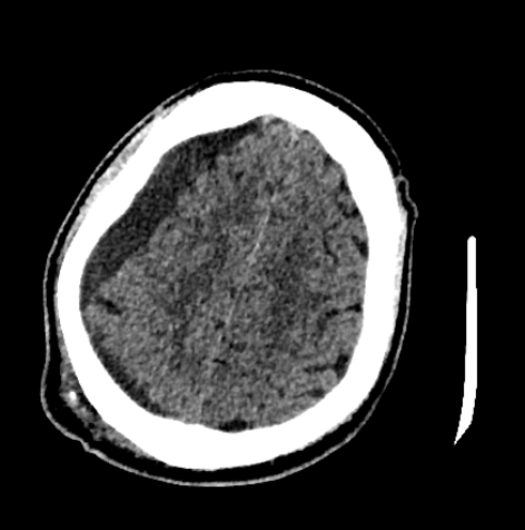 Normal pressure hydrocephalus (Radiopaedia 73685-84479 Axial non-contrast 62).jpg