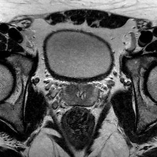 File:Normal prostate (MRI) (Radiopaedia 29986-30535 Axial T2 14).jpg