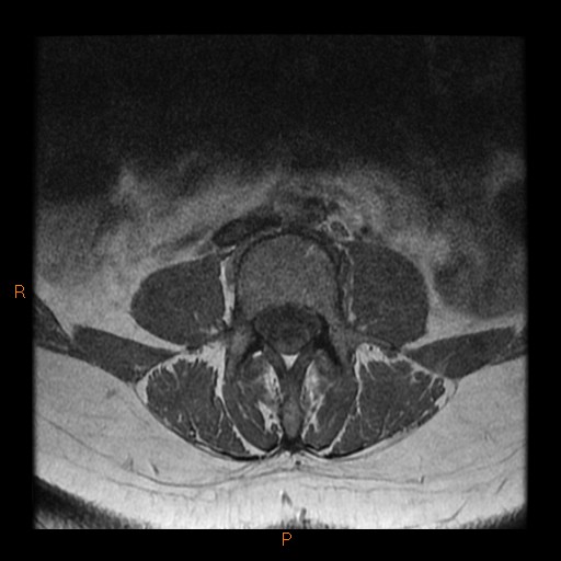 File:Normal spine MRI (Radiopaedia 77323-89408 Axial T1 10).jpg
