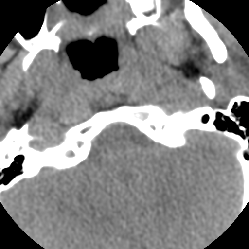 Normal trauma cervical spine (Radiopaedia 41017-43760 Axial non-contrast 7).png