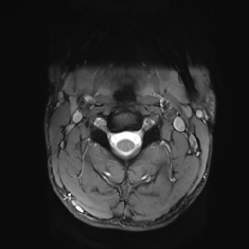 File:Normal trauma cervical spine (Radiopaedia 41017-43762 Axial T2 4).png