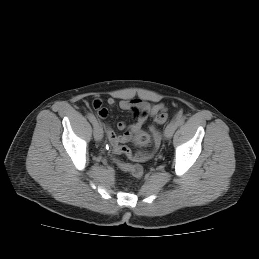 File:Obstructed kidney with perinephric urinoma (Radiopaedia 26889-27067 Axial non-contrast 45).jpg