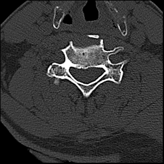 Occipital condyle fracture (type 1) (Radiopaedia 87670-104084 Axial bone window 56).jpg