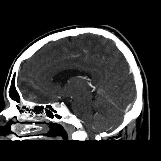 Occipital extradural hematoma simulating venous sinus thrombosis (Radiopaedia 46514-50964 D 36).jpg