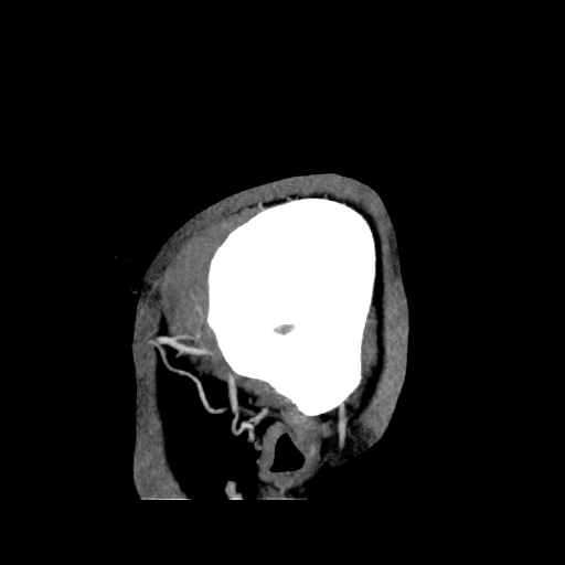 Occipital extradural hematoma simulating venous sinus thrombosis (Radiopaedia 46514-50964 D 5).jpg