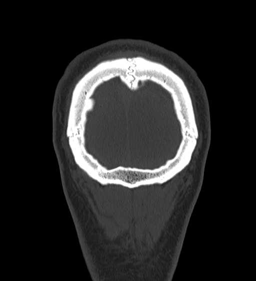Occipital spur and Currarino type A atlas anomaly (Radiopaedia 87027-103285 Coronal bone window 134).jpg