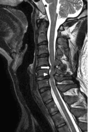 Image indicates C5–C6 with severe spinal cord compression (and large disc herniation at C4–C5 )