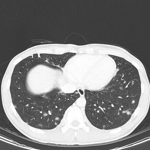 AIDS-related Kaposi sarcoma (Radiopaedia 85247-100811 Axial lung window 134).jpg