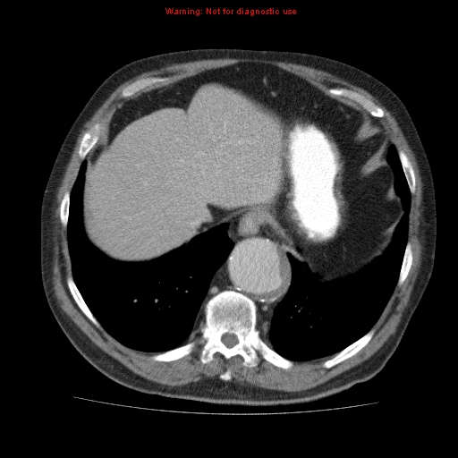 Abdominal aortic aneurysm (Radiopaedia 10122-10660 Axial C+ portal venous phase 10).jpg