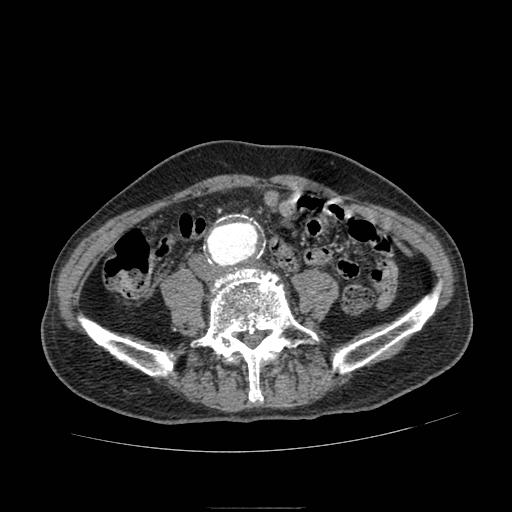 File:Abdominal aortic aneurysm (Radiopaedia 13341-13340 Axial C+ arterial phase 145).jpg
