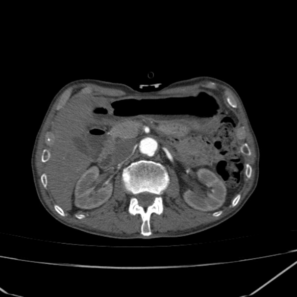 Abdominal aortic aneurysm (Radiopaedia 23703-23856 Axial C+ arterial phase 24).jpg
