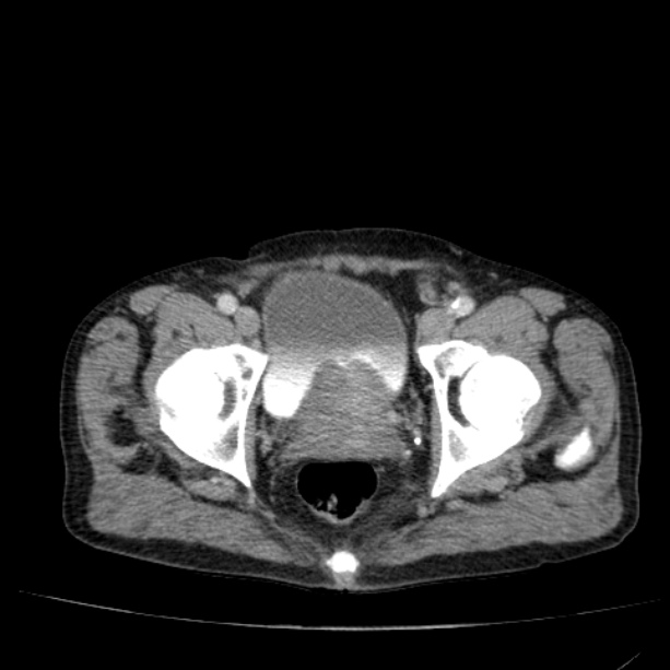 Abdominal aortic aneurysm (Radiopaedia 29248-29660 Axial C+ portal venous phase 58).jpg