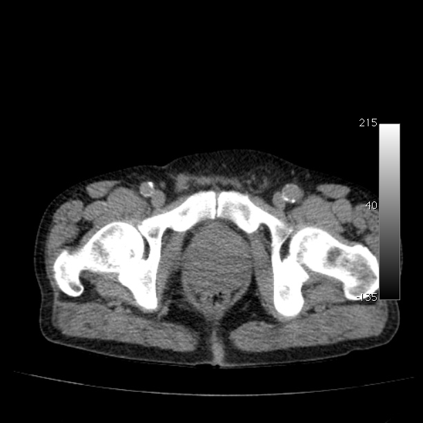 Abdominal aortic aneurysm (Radiopaedia 29248-29660 Axial non-contrast 57).jpg