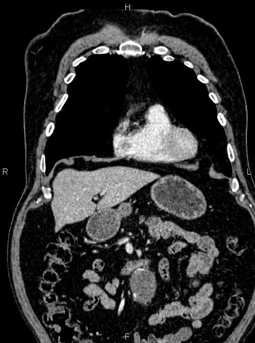 Abdominal aortic aneurysm (Radiopaedia 83094-97462 Coronal renal cortical phase 32).jpg