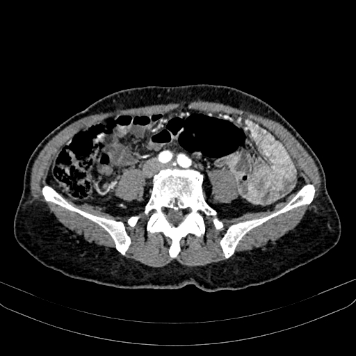 Abdominal aortic aneurysm (Radiopaedia 83581-98689 Axial C+ arterial phase 77).jpg