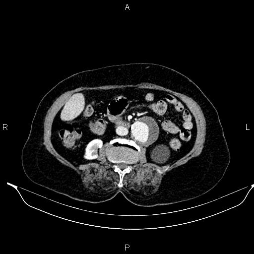 File:Abdominal aortic aneurysm (Radiopaedia 85063-100606 Axial C+ portal venous phase 41).jpg