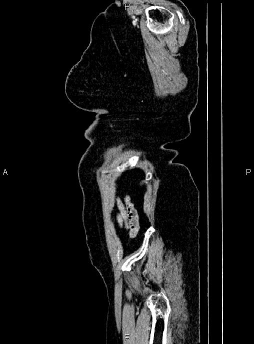 Abdominal aortic aneurysm (Radiopaedia 85063-100606 Sagittal C+ arterial phase 80).jpg