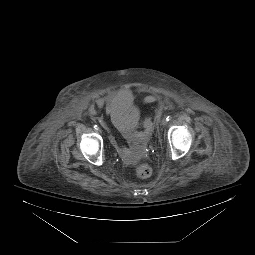 Abdominal aortic aneurysm - impending rupture (Radiopaedia 19233-19247 Axial non-contrast 147).jpg