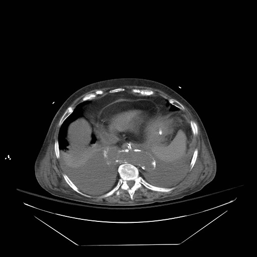 Abdominal aortic aneurysm - impending rupture (Radiopaedia 19233-19247 Axial non-contrast 28).jpg