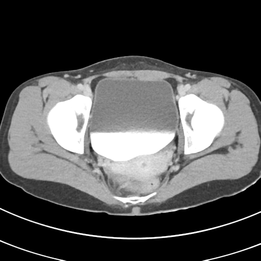 File:Abdominal multi-trauma - devascularised kidney and liver, spleen and pancreatic lacerations (Radiopaedia 34984-36486 Axial C+ delayed 74).png