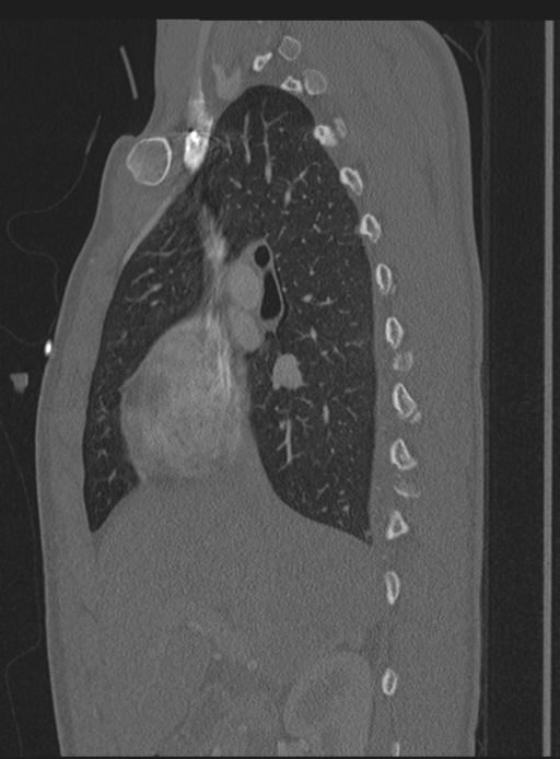 Abdominal multi-trauma - devascularised kidney and liver, spleen and pancreatic lacerations (Radiopaedia 34984-36486 Sagittal bone window 53).png