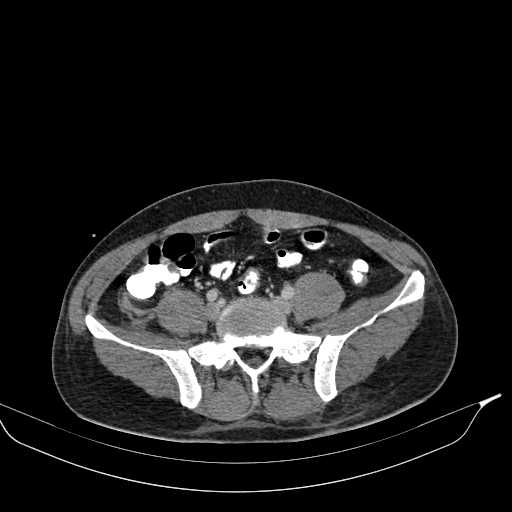 Abdominal multiorgan trauma (Radiopaedia 21792-21754 Axial C+ portal venous phase 38).jpg