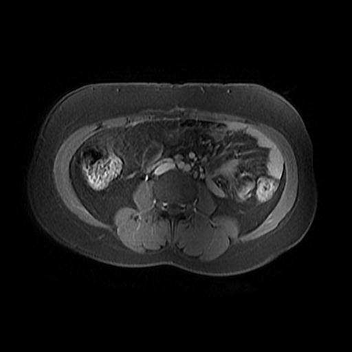 File:Abdominal wall endometriosis (Radiopaedia 83702-98847 Axial T1 C+ fat sat 7).jpg
