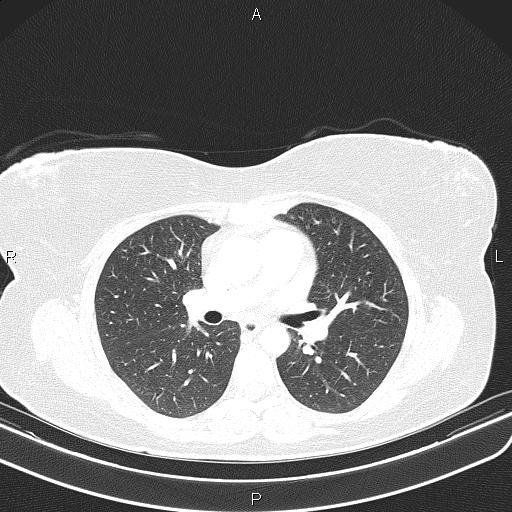 File:Aberrant right subclavian artery (Radiopaedia 87334-103629 Axial lung window 32).jpg