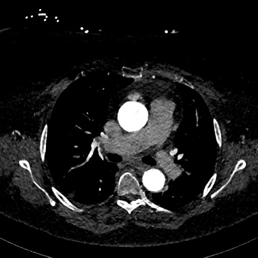 Aberrant right subclavian artery with Kommerell diverticulum (Radiopaedia 47982-52769 Axial C+ arterial phase 40).png