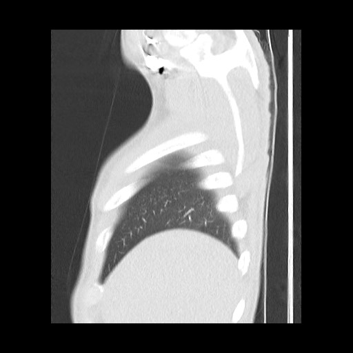Accessory left horizontal fissure with lingular pneumonia (Radiopaedia 53763-59843 Sagittal lung window 11).jpg
