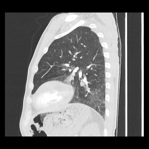 Accessory left horizontal fissure with lingular pneumonia (Radiopaedia 53763-59843 Sagittal lung window 49).jpg