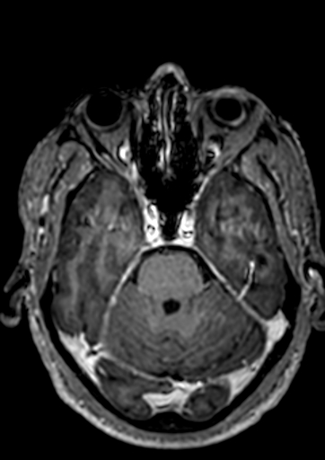 Accessory middle cerebral artery (Radiopaedia 73114-83828 Axial T1 C+ 104).jpg