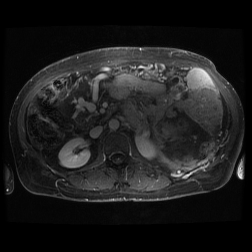 Acinar cell carcinoma of the pancreas (Radiopaedia 75442-86668 Axial T1 C+ fat sat 41).jpg