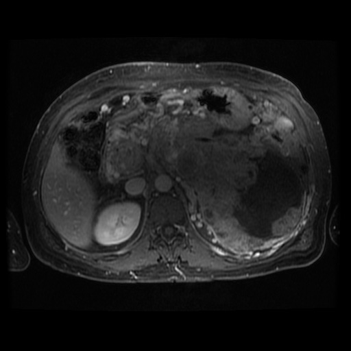 Acinar cell carcinoma of the pancreas (Radiopaedia 75442-86668 Axial T1 C+ fat sat 67).jpg