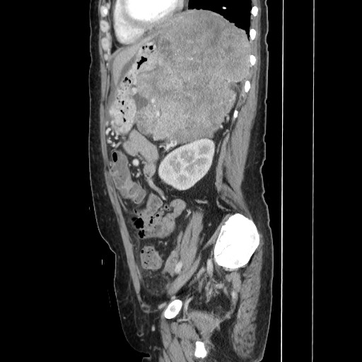 Acinar cell carcinoma of the pancreas (Radiopaedia 75442-86669 Sagittal C+ portal venous phase 128).jpg