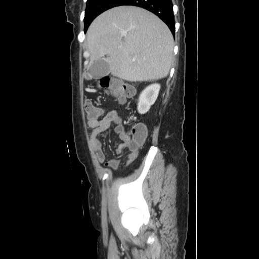 Acinar cell carcinoma of the pancreas (Radiopaedia 75442-86669 Sagittal C+ portal venous phase 55).jpg