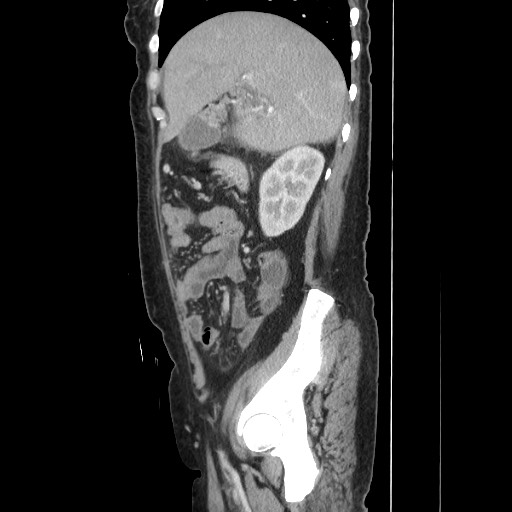 File:Acinar cell carcinoma of the pancreas (Radiopaedia 75442-86669 Sagittal C+ portal venous phase 62).jpg
