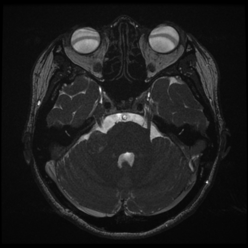 Acoustic neuroma (Radiopaedia 34049-35283 Axial 66).png