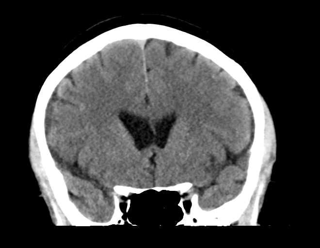 File:Acoustic schwannoma (Radiopaedia 33045-34065 Coronal non-contrast 18).png