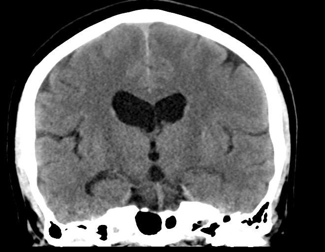 File:Acoustic schwannoma (Radiopaedia 33045-34065 Coronal non-contrast 24).png