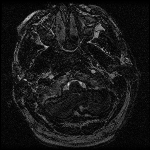 File:Acoustic schwannoma (Radiopaedia 39170-41387 Axial FIESTA 10).png