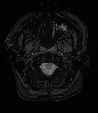 Acoustic schwannoma (Radiopaedia 50846-56358 Axial SWI 4).png
