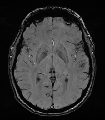 Acoustic schwannoma (Radiopaedia 50846-56358 Axial SWI 47).png