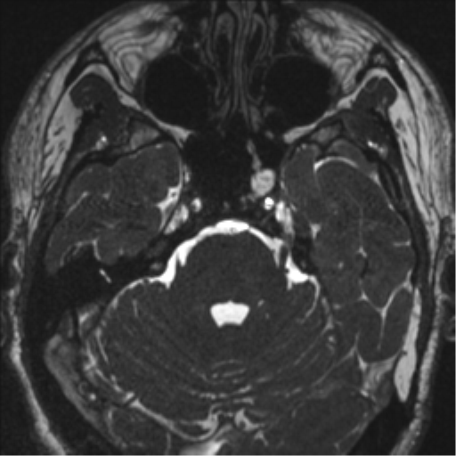 Acoustic schwannoma (translabyrinthine resection) (Radiopaedia 43570-46972 Axial CISS 39).png